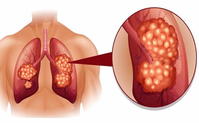Bệnh liên quan đến phổi