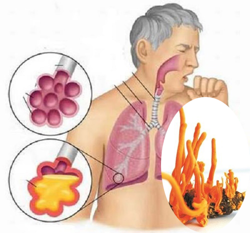 Đông trùng hạ thảo và bệnh phổi