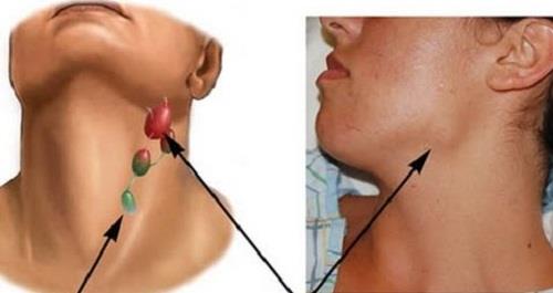 Các dấu hiệu cảnh báo bệnh ung thư vòm họng nên chú ý